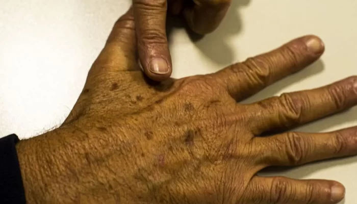 desinformacao-sobre-cancer-de-pele-afeta-diagnostico-diz-instituicao1776180486-1450x850-0b46b3b5.web_.webp