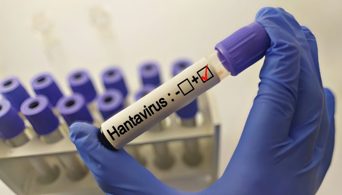 hantavirus-scaled.jpg