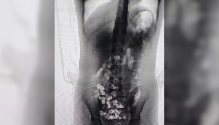 menina-de-13-anos-e-flagrada-com-32-porcoes-de-drogas-escondidas-no-corpo-em-presidio-de-chapeco-df1.png